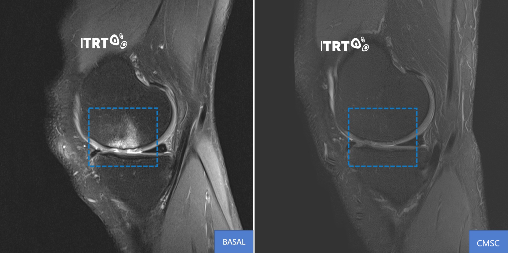 Knee cartilage regeneration