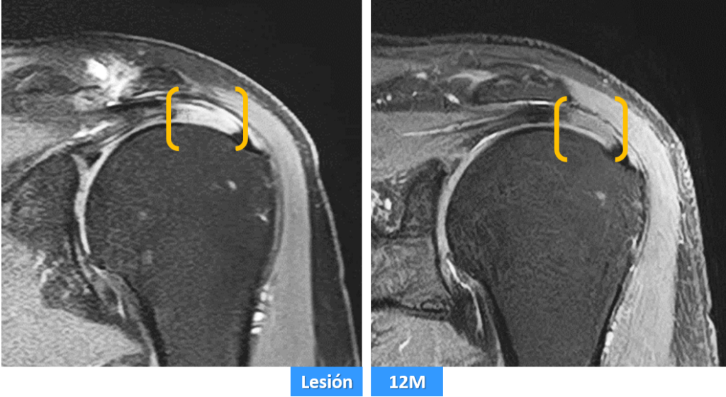 Rotura del Supraespinoso y regeneración con células madre