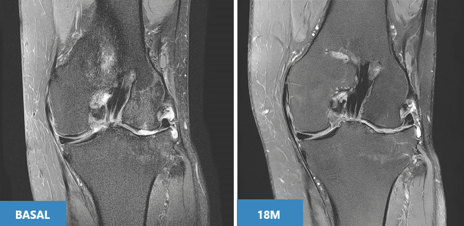 Artrosis de Rodilla