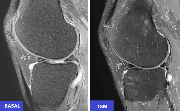 Osteoarthritis and regeneration with cultured stem cells