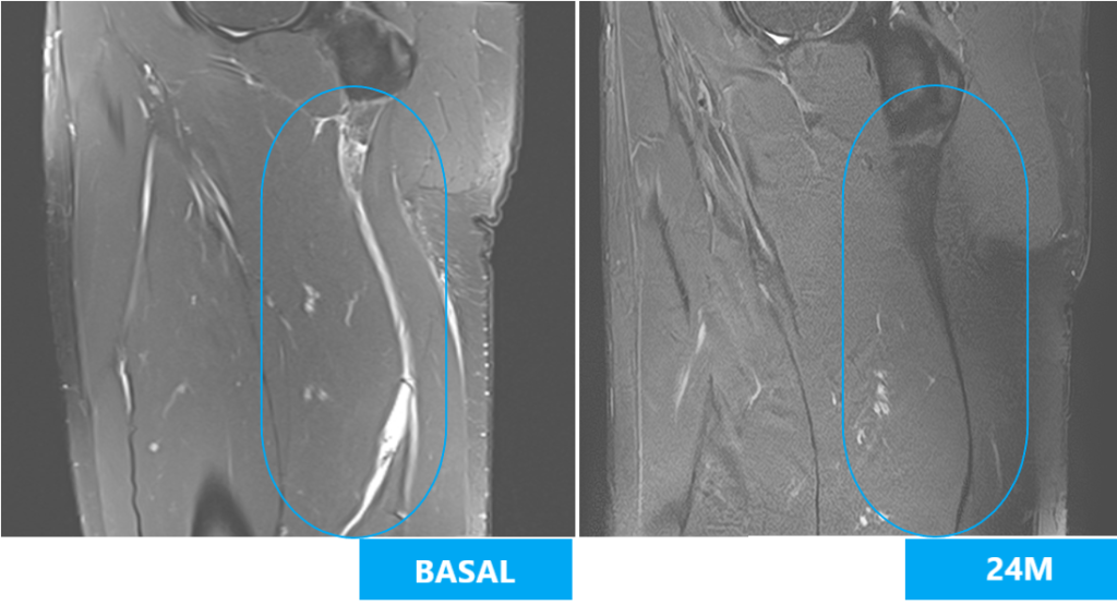 Hamstring tear