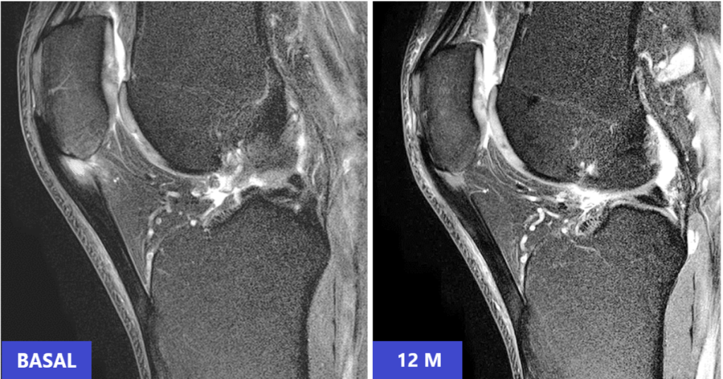 Patellar tendon tear and regeneration