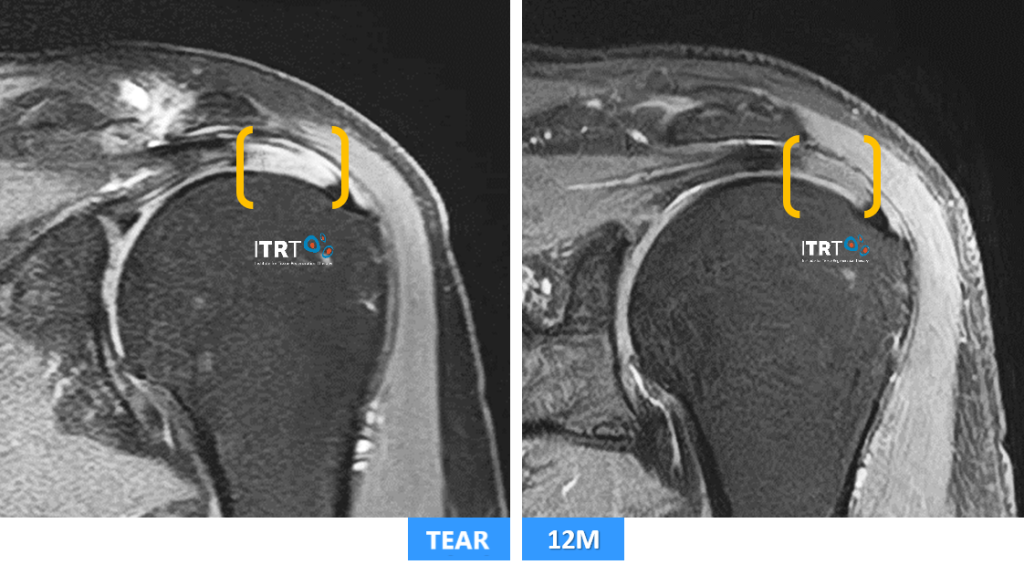 Rotator cuff tear and regeneration with cultured stem cells