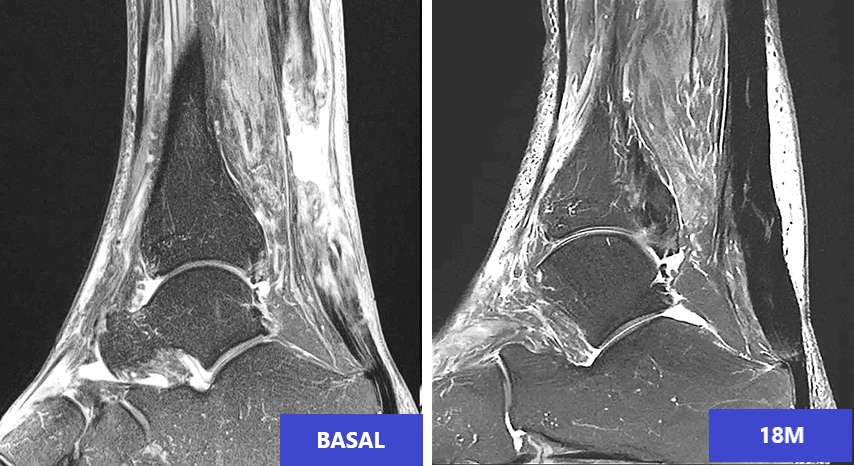 Achilles Tendon Rupture and Regeneration with Cultured Stem Cells