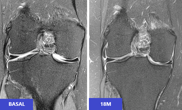 Osteoarthritis and regeneration with cultured stem cells