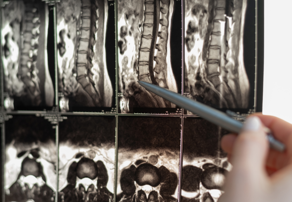 Degenerative Disc Disease